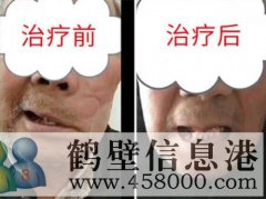 鶴壁面肌痙攣治療的方法